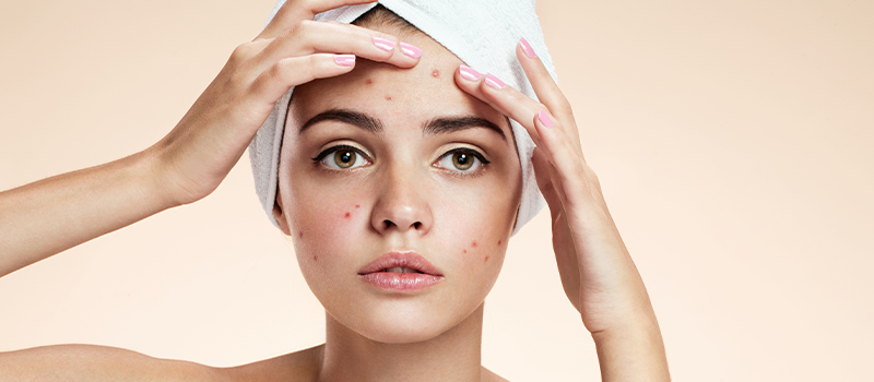 NikkieTutorials tells: Suffering from acne? Here's how to get rid of it!
